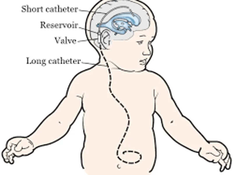 Child VP shunt surgery in Deoghar