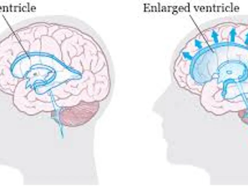VP Shunt Surgery in Deoghar | Cost, Best Surgeons & Hydrocephalus Treatment