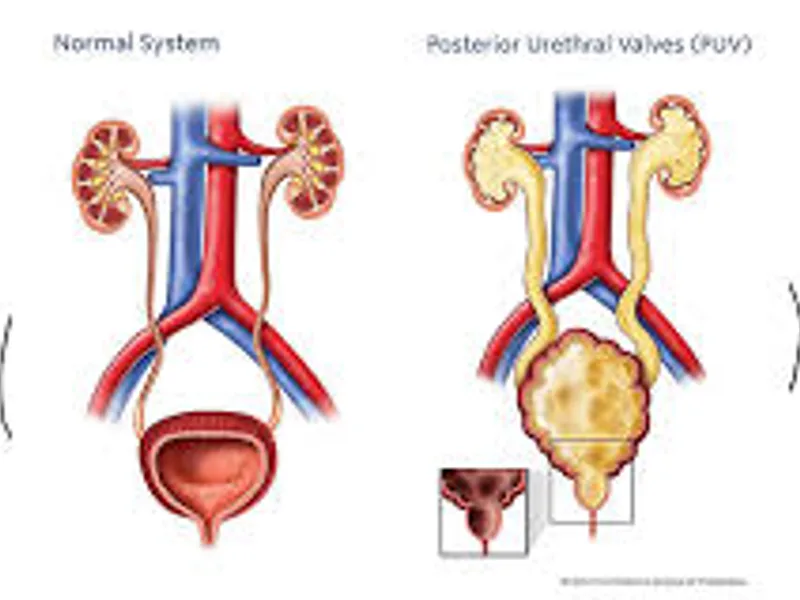 Child cystoscopic PU valve fulguration surgery in Deoghar