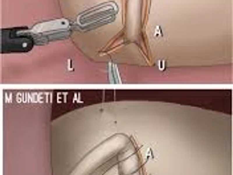 Child ureteric reimplantation unilateral surgery in Deoghar