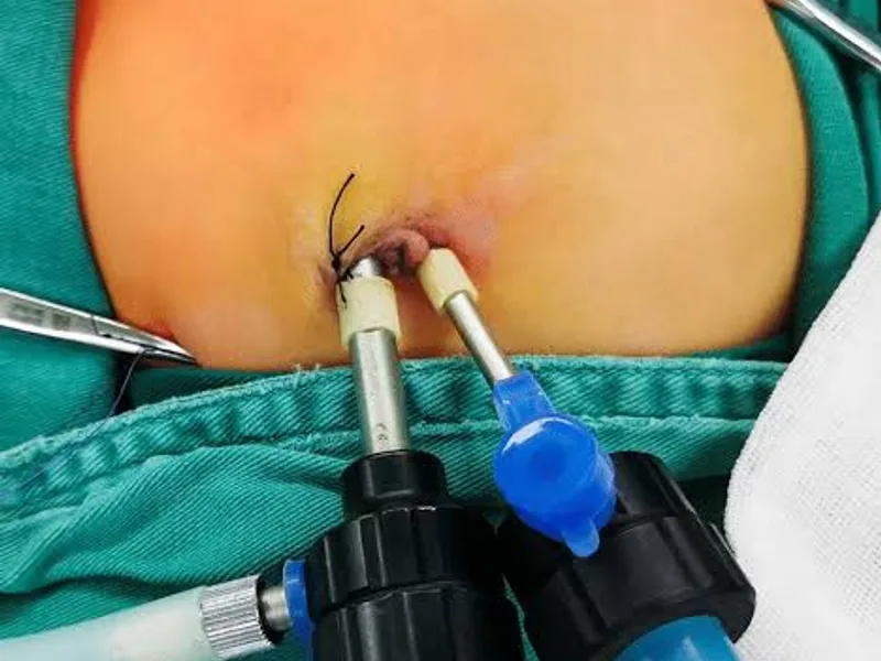 Female Congenital Pyloric Stenosis Operation in Deoghar