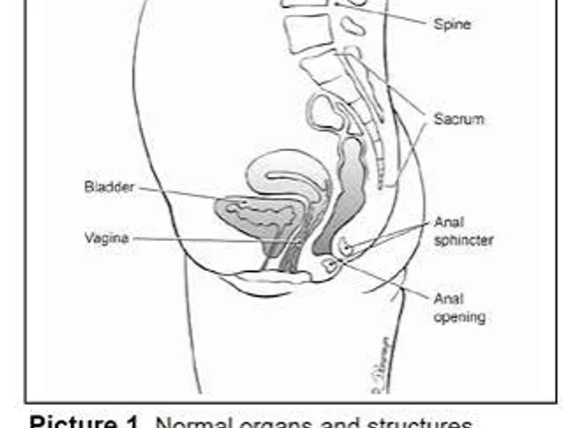 Female Imperforate Anus Low Anomaly Perineal Anoplasty in Deoghar