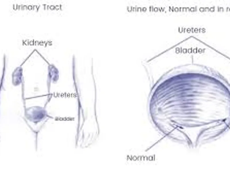 Child ureteric reimplantation bilateral surgery in Deoghar