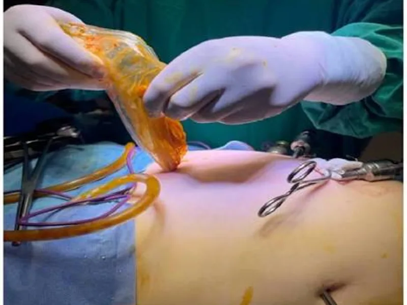 Female Hydatid Cyst Surgery in Deoghar