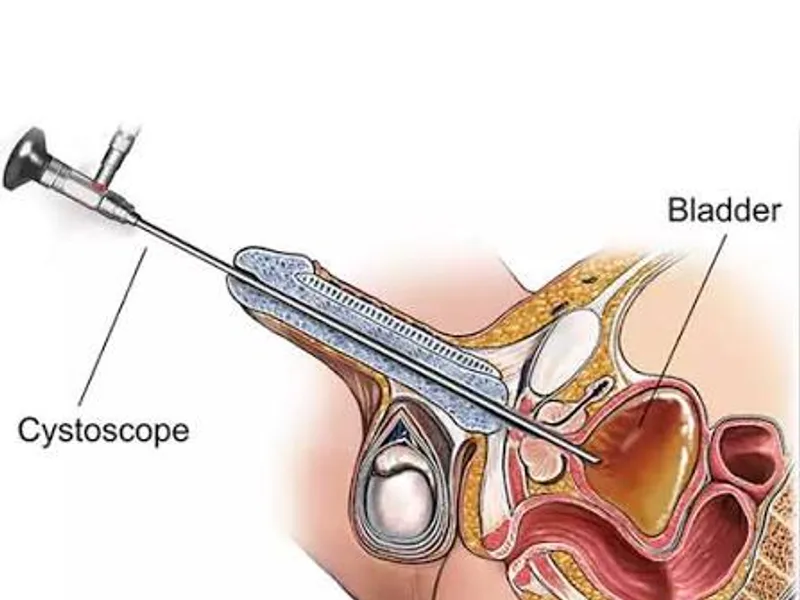 Female Cystoscopic Deroofing Surgery in Deoghar
