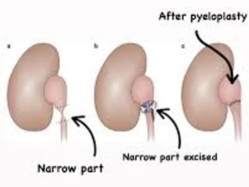 Pyeloplasty Surgery in Deoghar | Cost, Best Surgeons & UPJ Obstruction Treatment