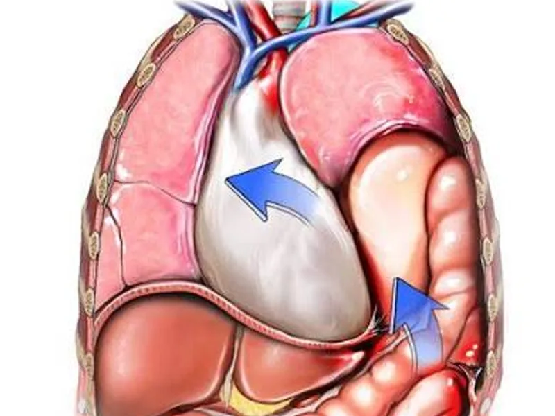 Female Diaphragmatic Hernia Repair Surgery in Deoghar