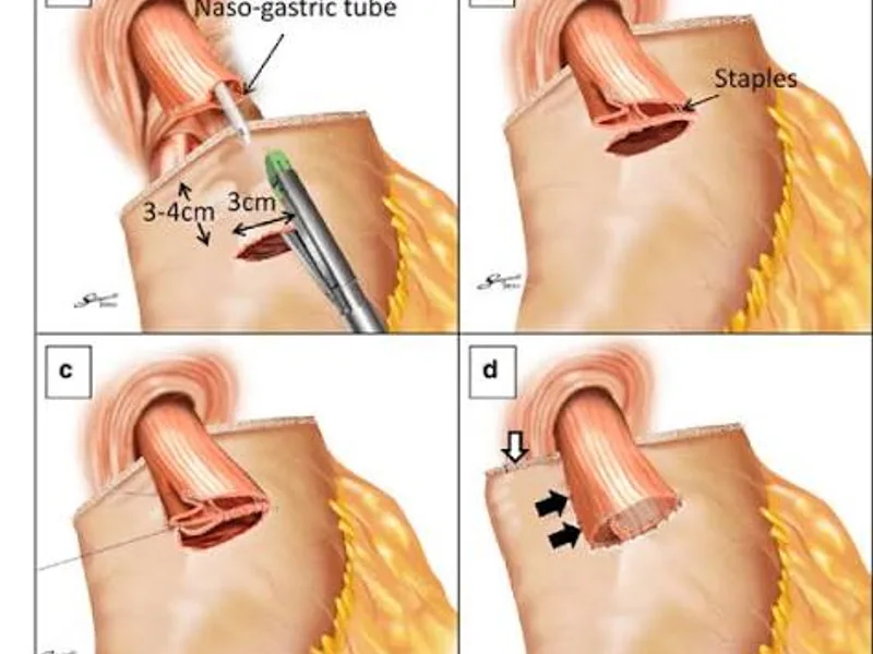 Female Esophagostomy Gastrostomy Surgery in Deoghar