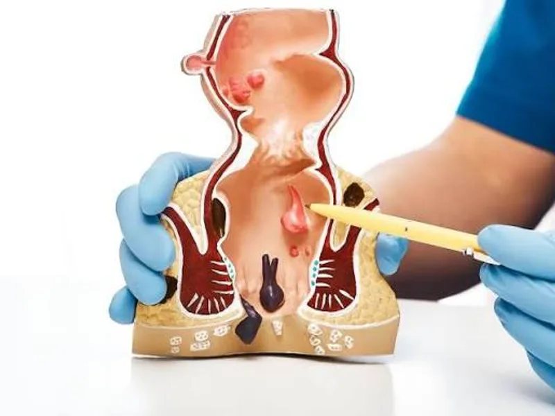 Female Tracheoesophageal Fistula Correction Surgery in Deoghar