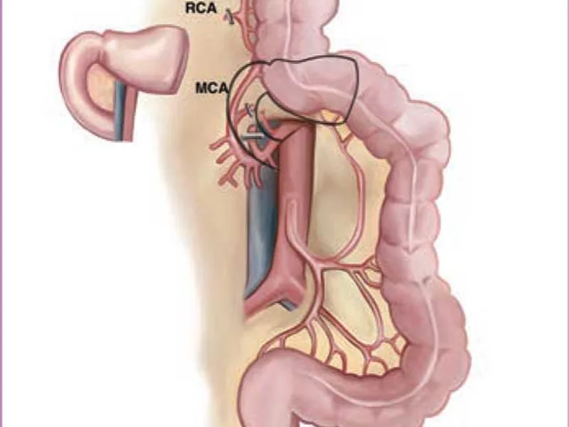 Female Colon Replacement of Esophagus Surgery in Deoghar