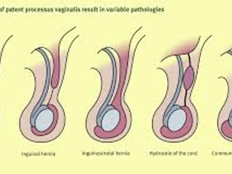 Congenital Hydrocele & Inguinal Herniotomy Surgery in Deoghar | Best Pediatric Surgeons & Child Surgery Care