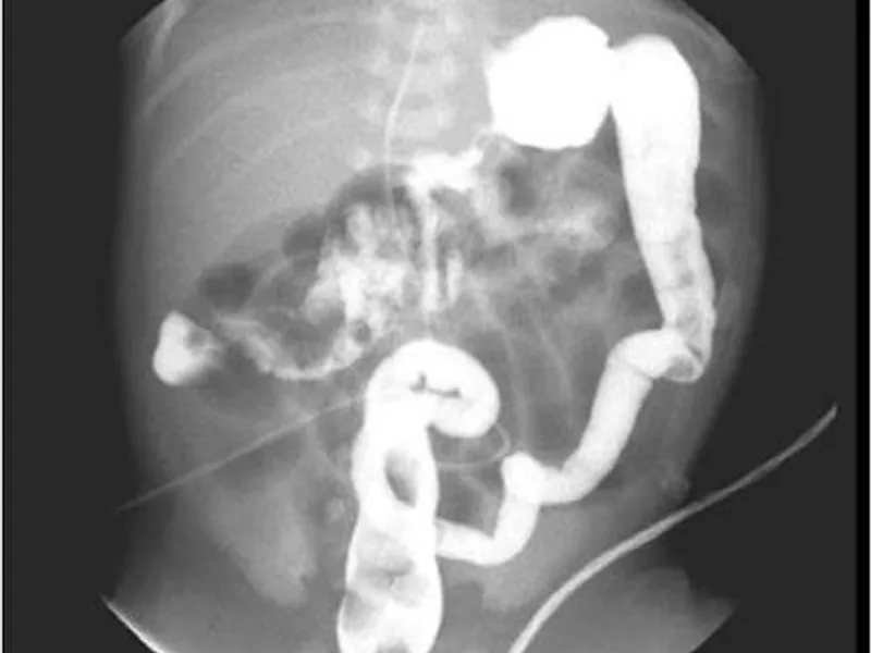 Female Meconium Ileus Surgery in Deoghar | Neonatal Surgeons