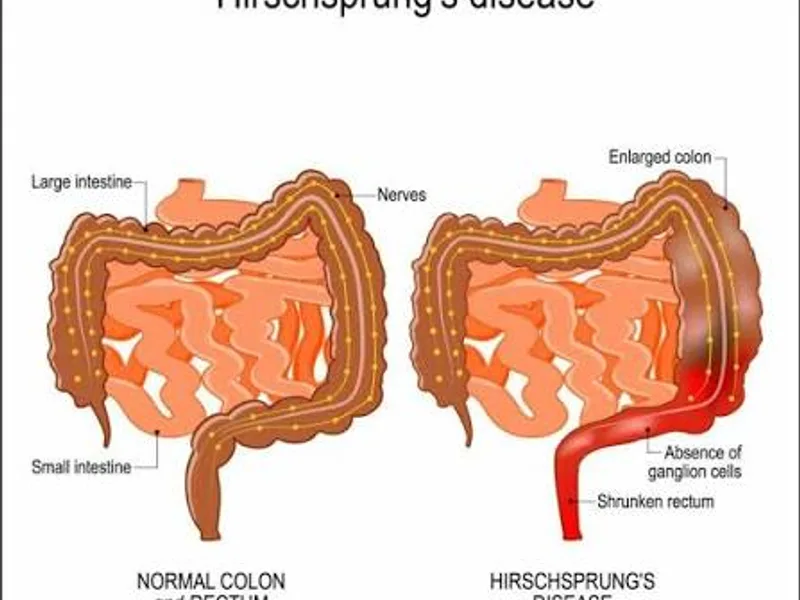 Female Hirschsprung Disease Surgery in Deoghar