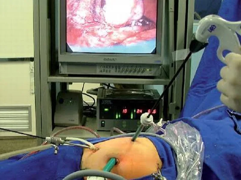 Female Nephrectomy for Wilms Tumour Surgery in Deoghar