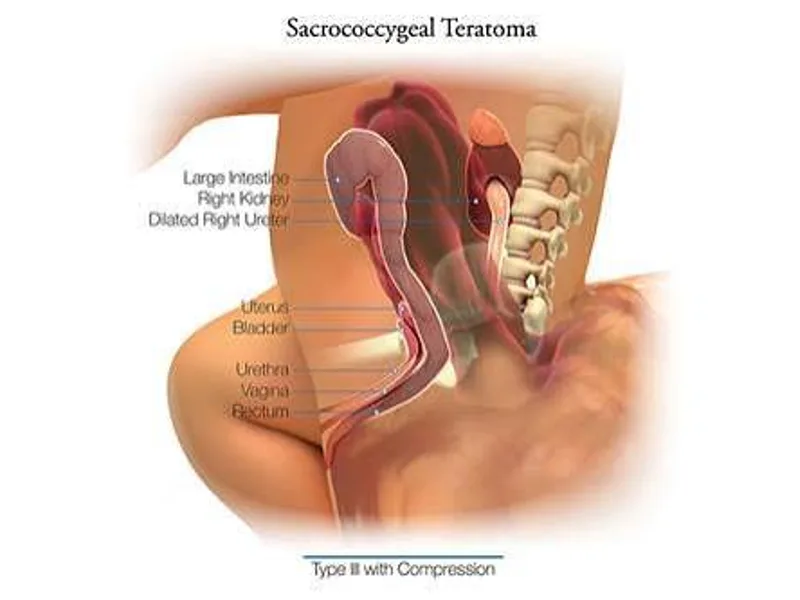 Female Sacrococcygeal Teratoma Excision Surgery in Deoghar