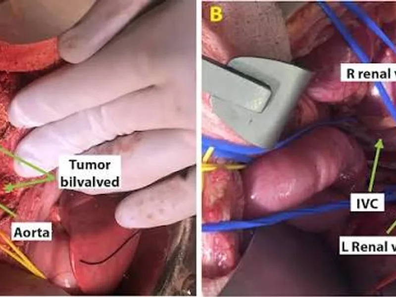 Female Neuroblastoma Total Excision Surgery in Deoghar