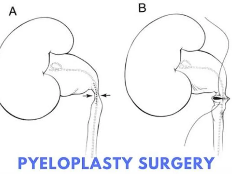 Female Pyeloplasty Surgery in Deoghar