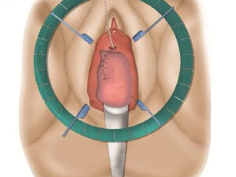 Female Urethroplasty Surgery in Deoghar