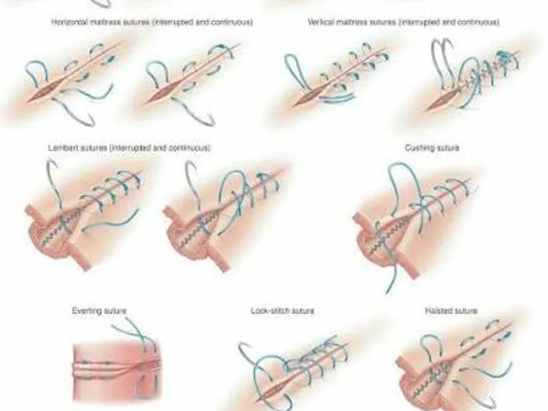Female Suturing Stitches Surgery in Deoghar