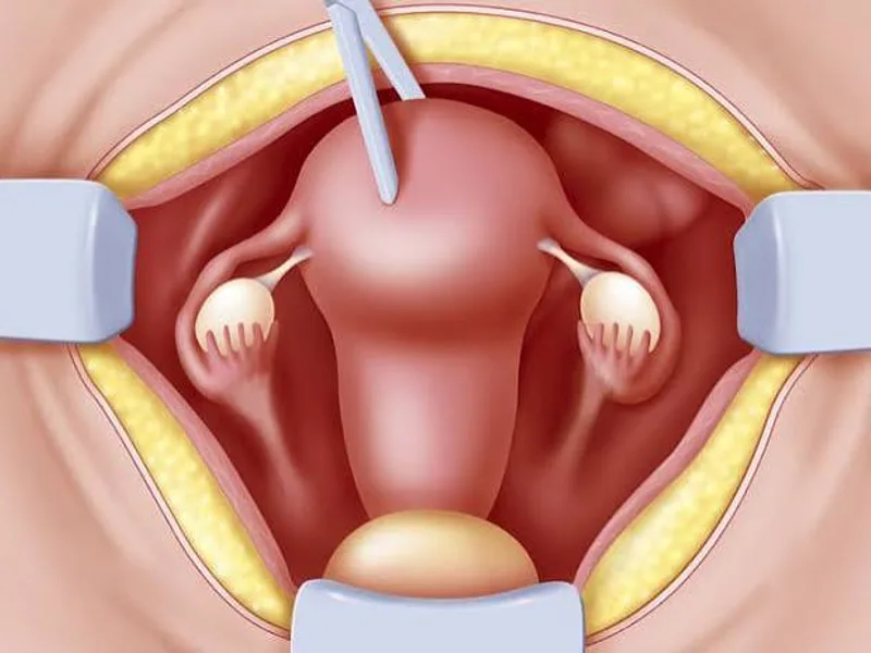 Female Hysterectomy Surgery in Deoghar