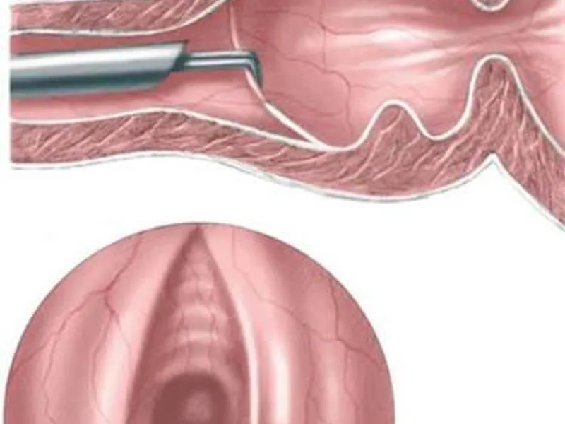 Female Cystoscopic PU Valve Fulguration Surgery in Deoghar