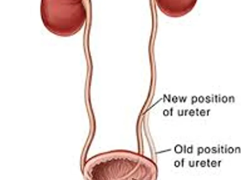 Female Ureteric Reimplantation Unilateral Surgery in Deoghar