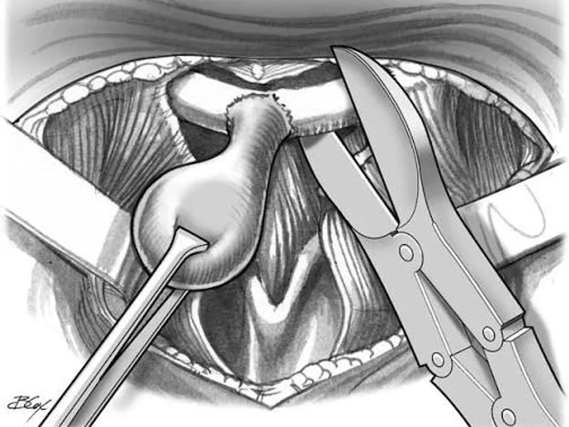 Female Excision of Thyroglossal Duct Cyst Surgery in Ranchi