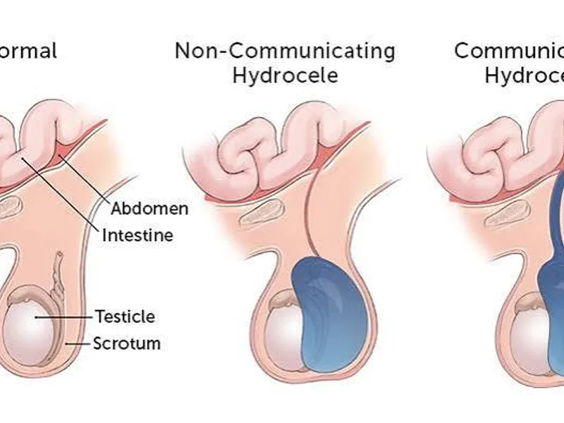 Female Congenital Hydrocele Surgery in Ranchi
