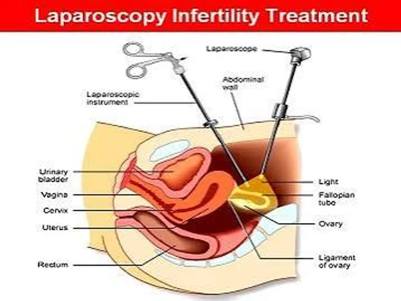 Female Diagnostic Laparoscopy Surgery in Ranchi
