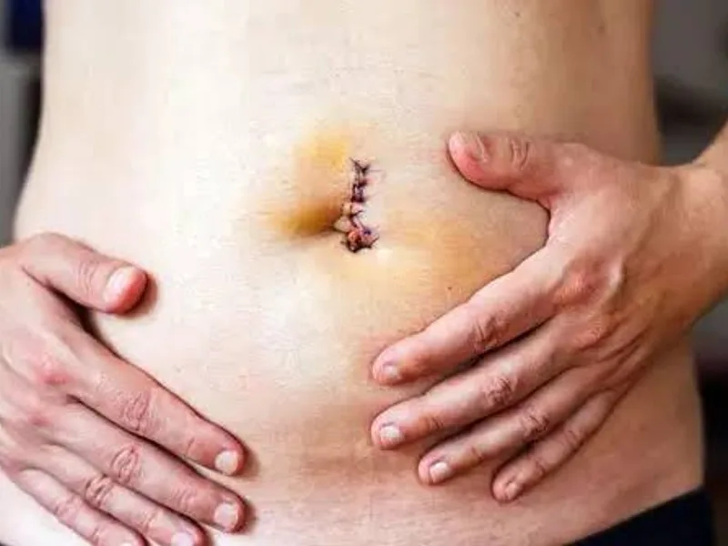 Female Umbilical Hernia Repair Surgery in Ranchi