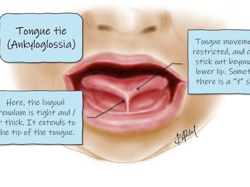 Female Tongue Tie Excision Surgery in Ranchi