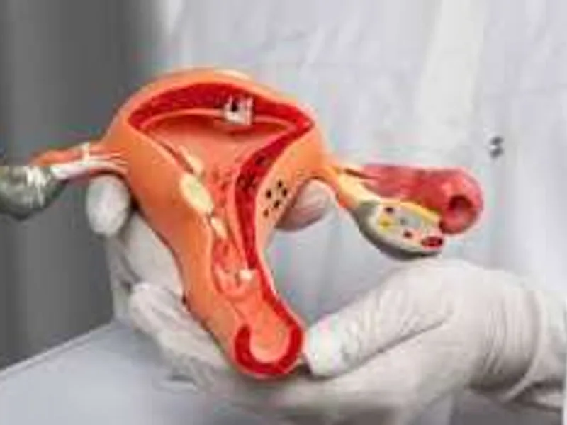 Female Excision of Cyst Surgery in Ranchi