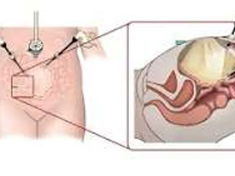 Female Omphalo Mesenteric Cyst Excision Surgery in Ranchi