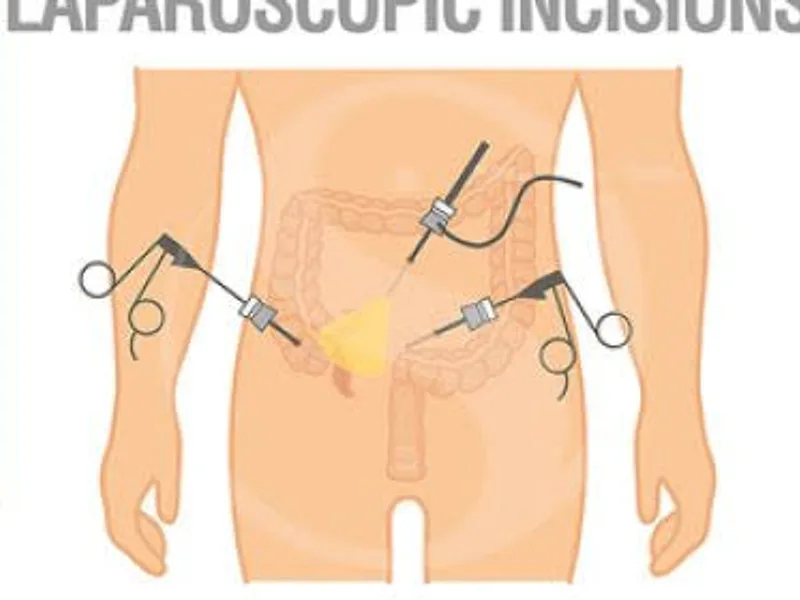 Female Open Appendectomy Surgery in Ranchi