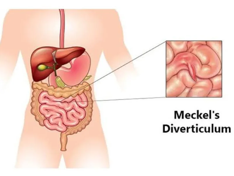 Female Meckel's Diverticulectomy Surgery in Ranchi