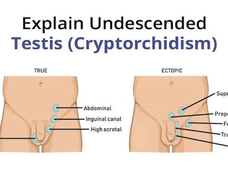 Female Undescended Testis Unilateral Surgery in Ranchi
