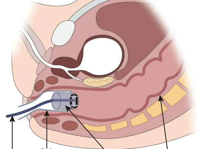 Female Removal of Foreign Body Surgery in Ranchi