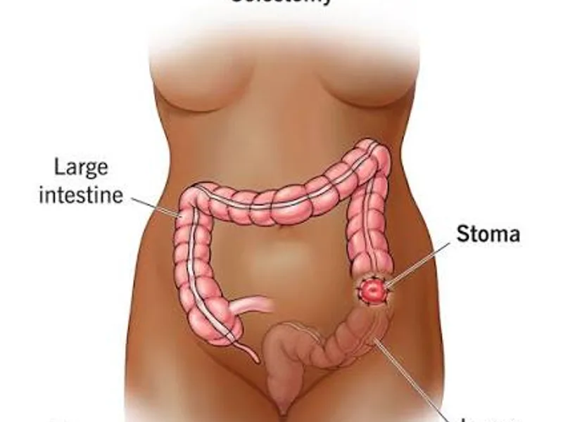 Female Colostomy Surgery in Ranchi