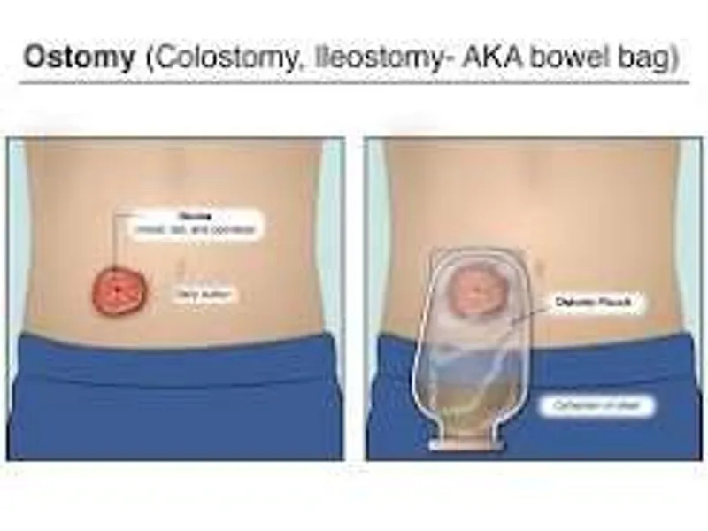 Female Colostomy with Multiple Biopsy for Hirschsprung Disease in Ranchi