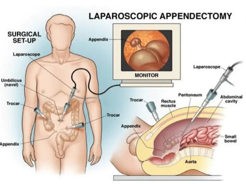 Female Laparoscopic Appendectomy Surgery in Ranchi