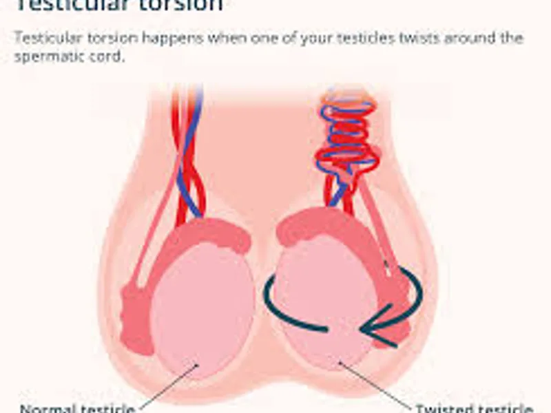 Female Torsion Testis Operation in Ranchi