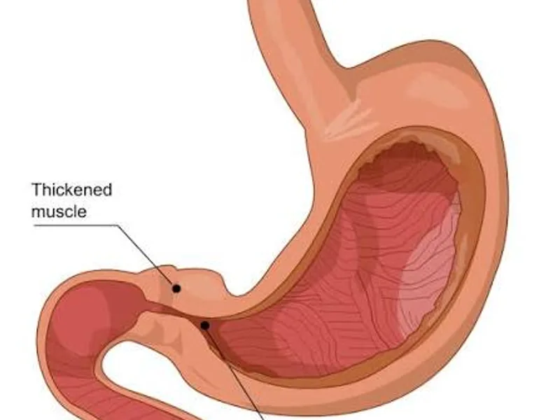 Female Congenital Pyloric Stenosis Operation in Ranchi