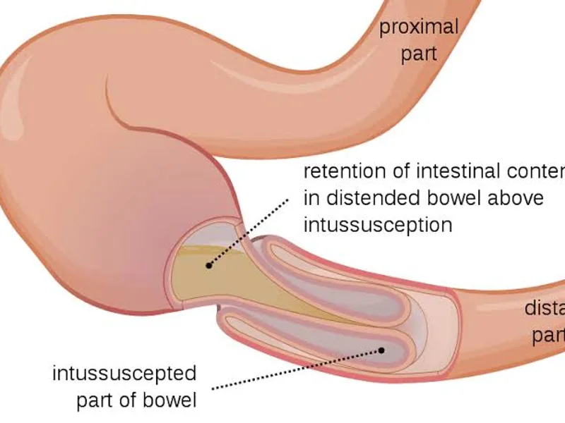 Female Intussusception Operation Surgery in Ranchi