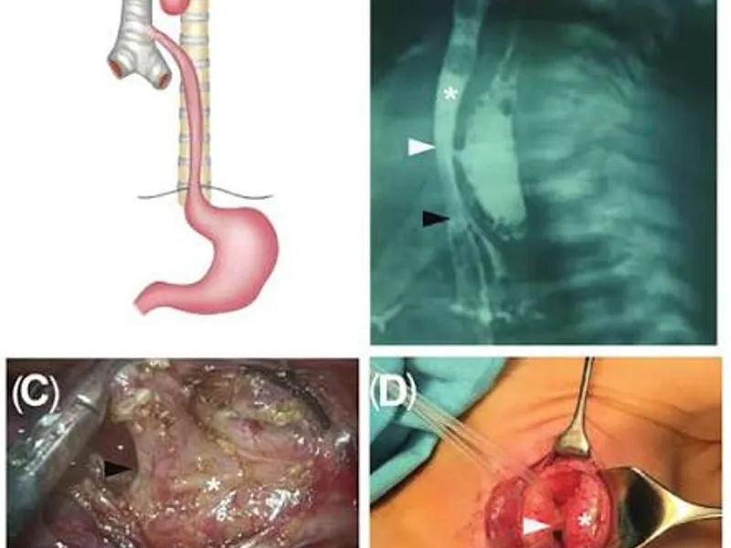 Female Tracheoesophageal Fistula Correction Surgery in Ranchi