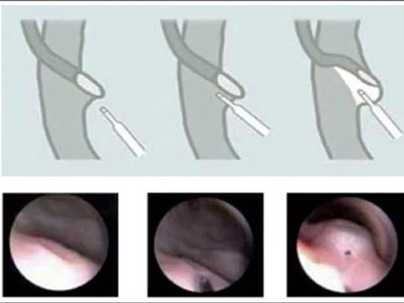 Female Cystoscopic Deflux Injection Surgery in Ranchi
