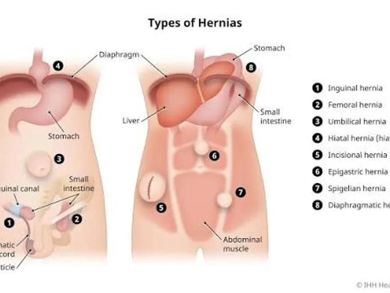 Female Diaphragmatic Hernia Repair Surgery in Ranchi