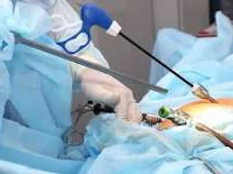 Female Laparoscopic Abdominal Cyst Operation in Ranchi