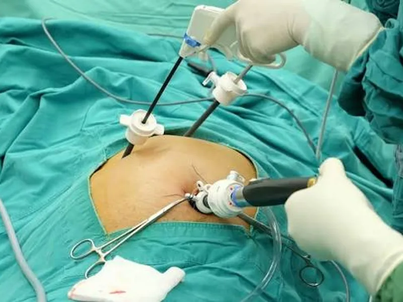 Female Laparoscopic Cholecystectomy Surgery in Ranchi