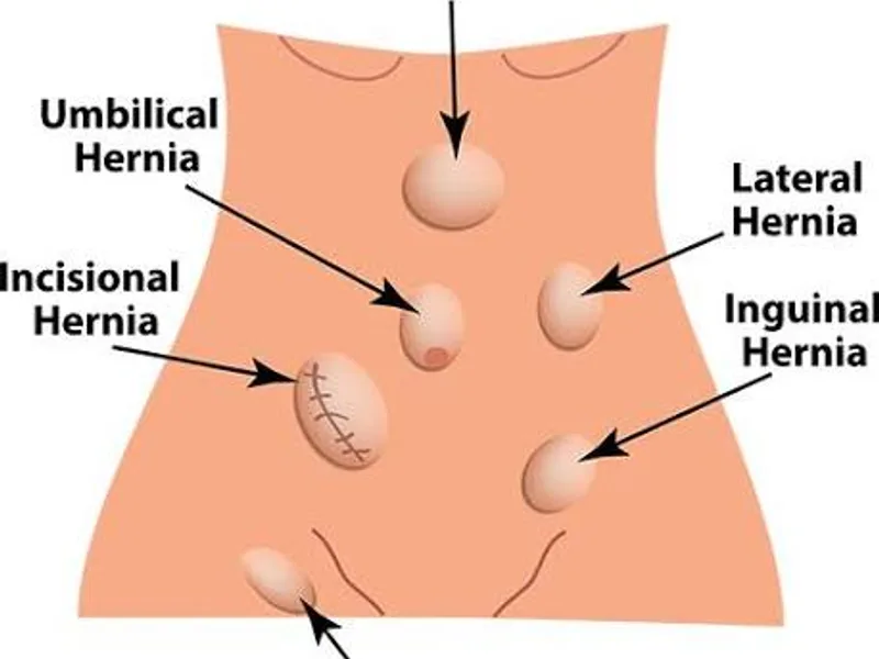 Female Omphalocele First Stage Hernia Repair Surgery in Ranchi