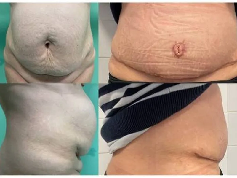 Female Omphalocele Second Stage Hernia Repair Surgery in Ranchi